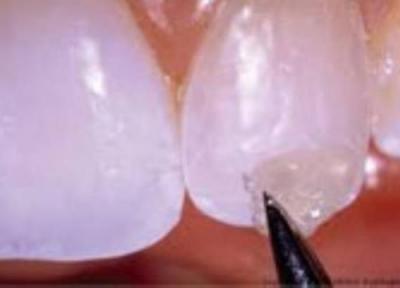 دندان های نقره ای